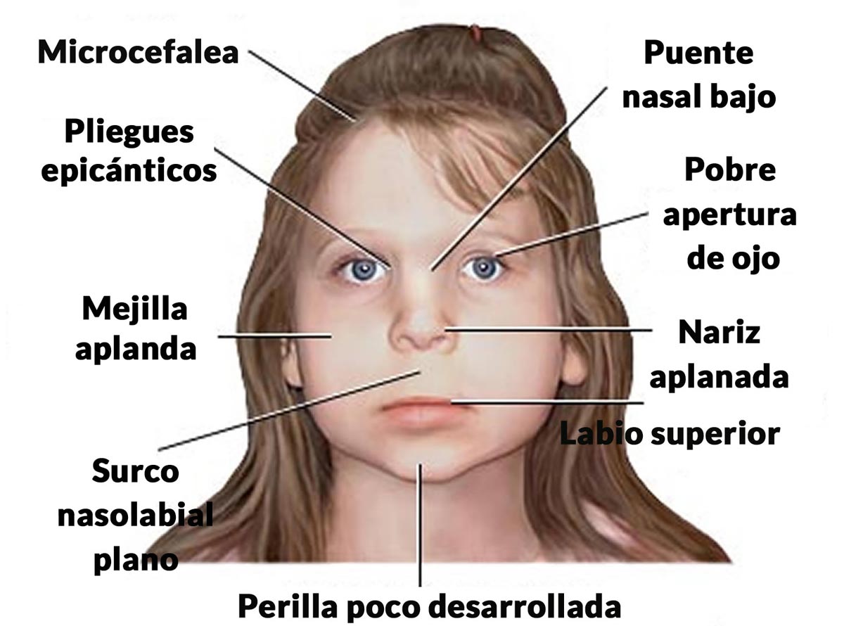 S ndrome Alcoh lico Fetal C mo S Si Mi Hijo a Lo Tiene Adictalia S ndrome Alcoh lico Fetal C mo S Si Mi Hijo a Lo Tiene Adictalia